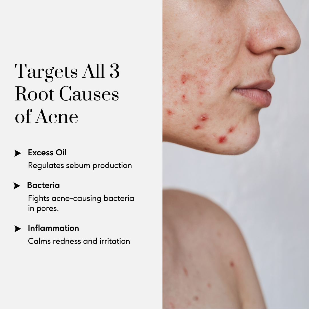 Acne Clear Drops with Retinyl Palmitate, Cica and Zinc
