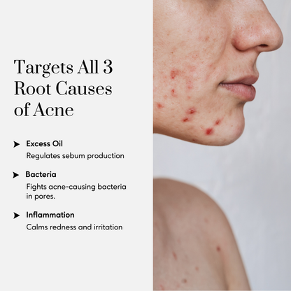 Acne Clear Drops with Retinyl Palmitate, Cica and Zinc