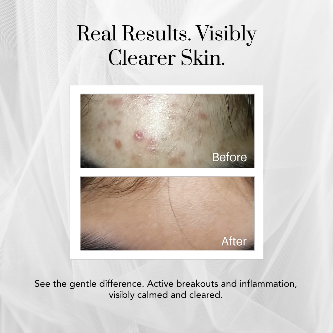 Acne Clear Drops with Retinyl Palmitate, Cica and Zinc